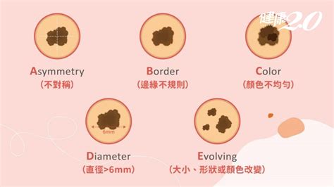 乳頭長痣|是痣還是瘤？黑色素瘤的類型、症狀與治療